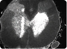 A greyscale cross-section micrograph of a spinal cord, showing the characteristic internal butterfly-shaped gray matter surrounded by white matter tracts